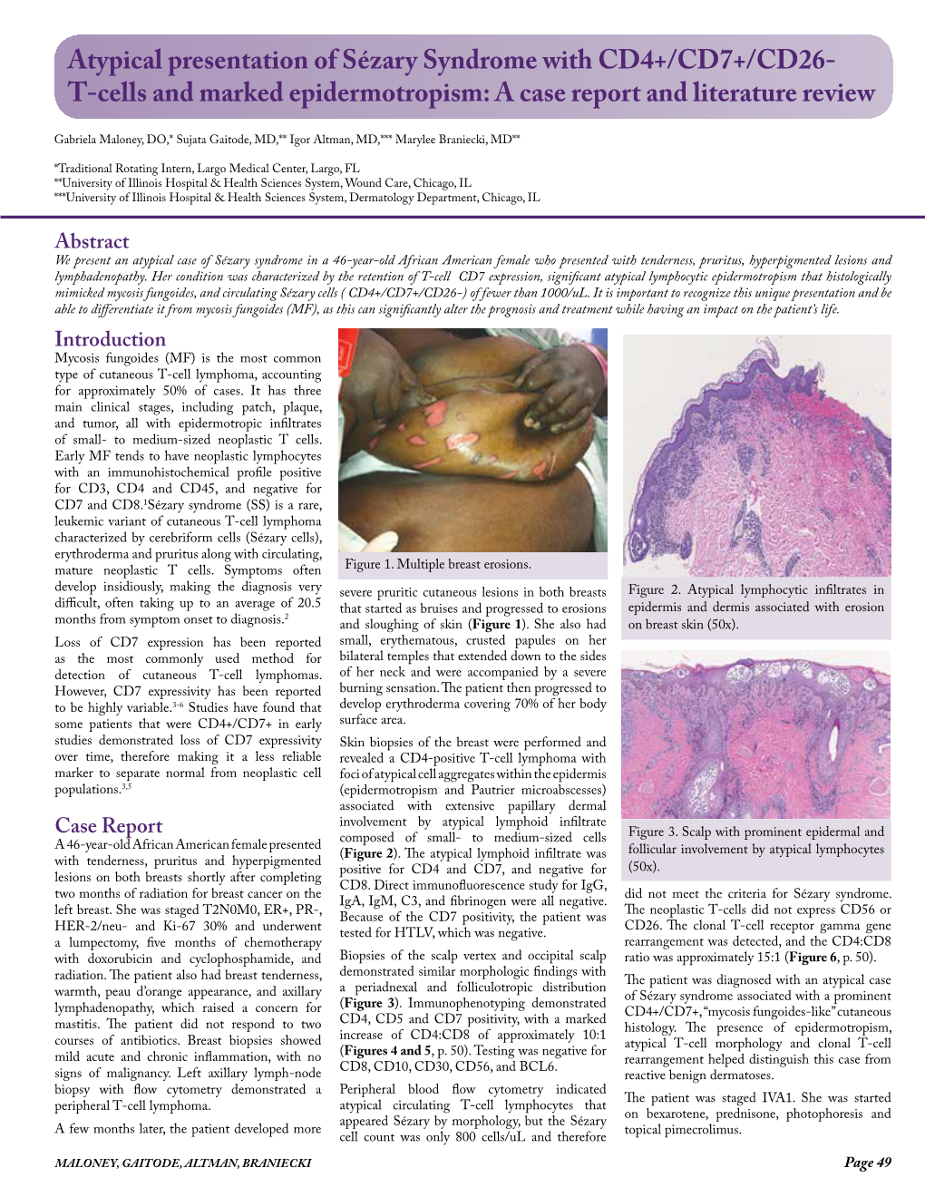 Atypical Presentation of Sézary Syndrome with CD4+/CD7+/CD26- T-Cells and Marked Epidermotropism: a Case Report and Literature Review