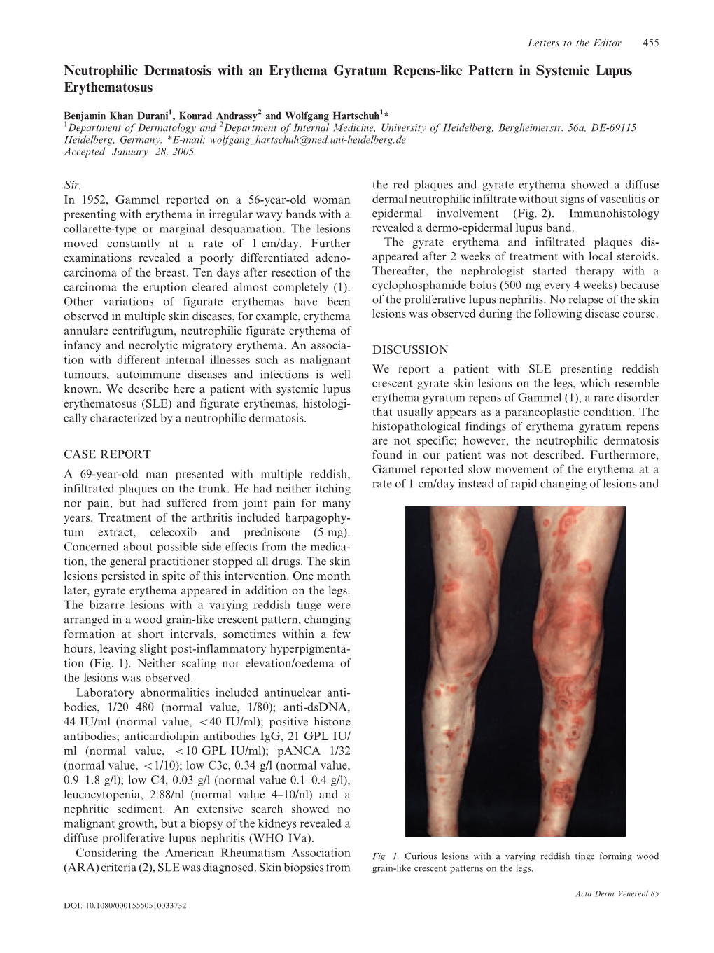 Neutrophilic Dermatosis with an Erythema Gyratum Repens-Like Pattern in Systemic Lupus Erythematosus