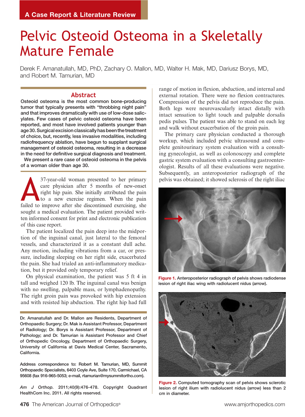 Pelvic Osteoid Osteoma in a Skeletally Mature Female