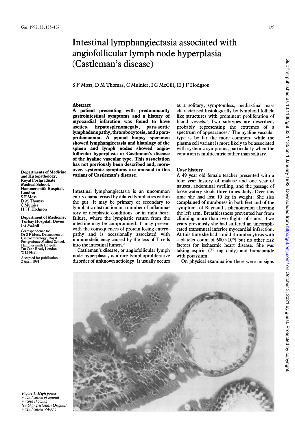 Intestinal Lymphangiectasia Associated with (Castleman's