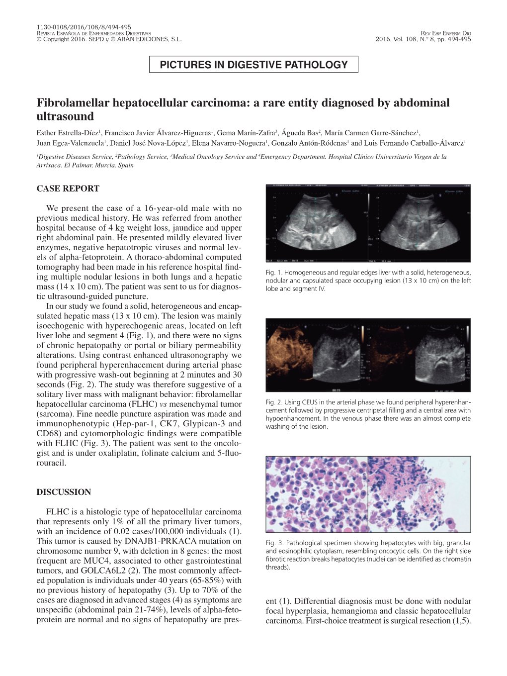 Fibrolamellar Hepatocellular Carcinoma: a Rare Entity Diagnosed