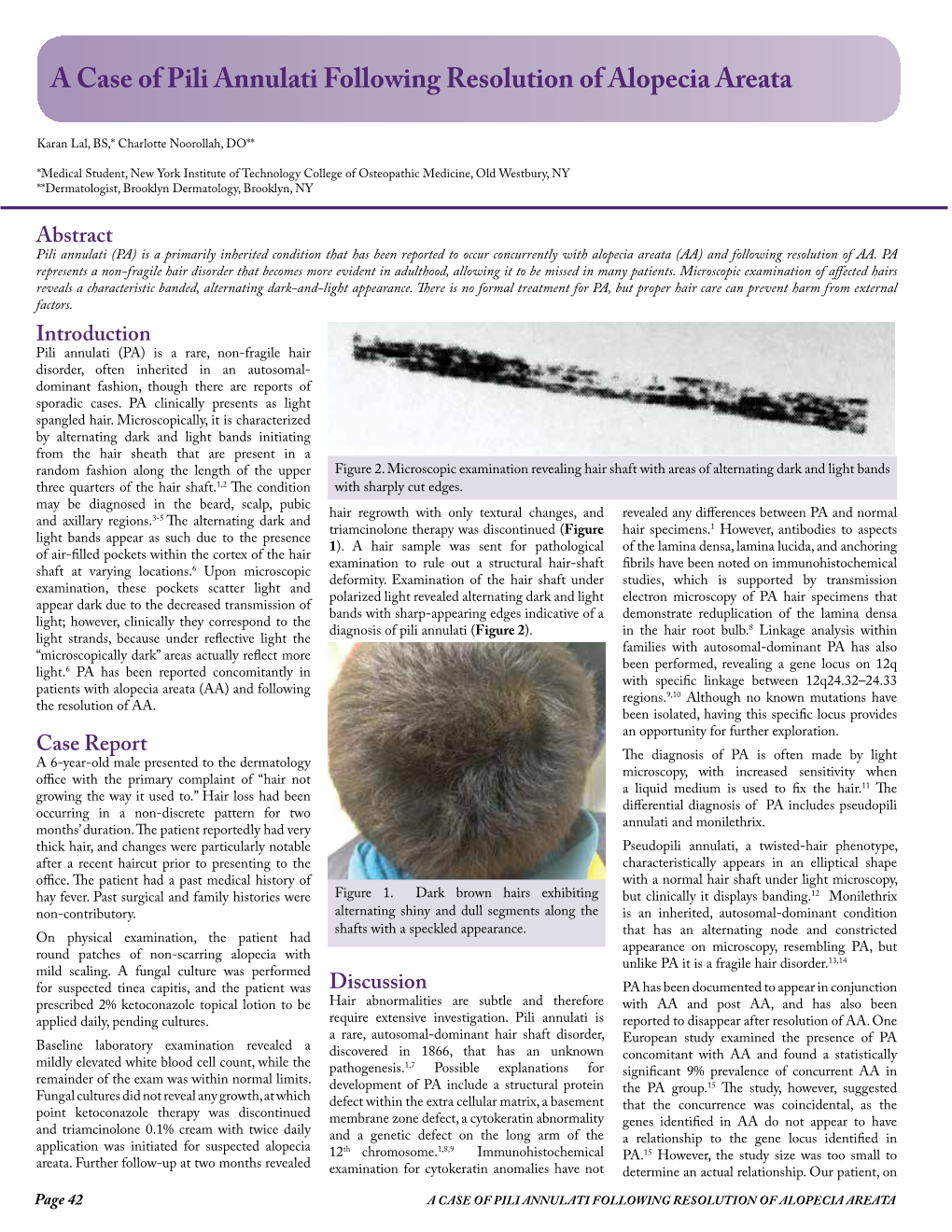A Case of Pili Annulati Following Resolution of Alopecia Areata