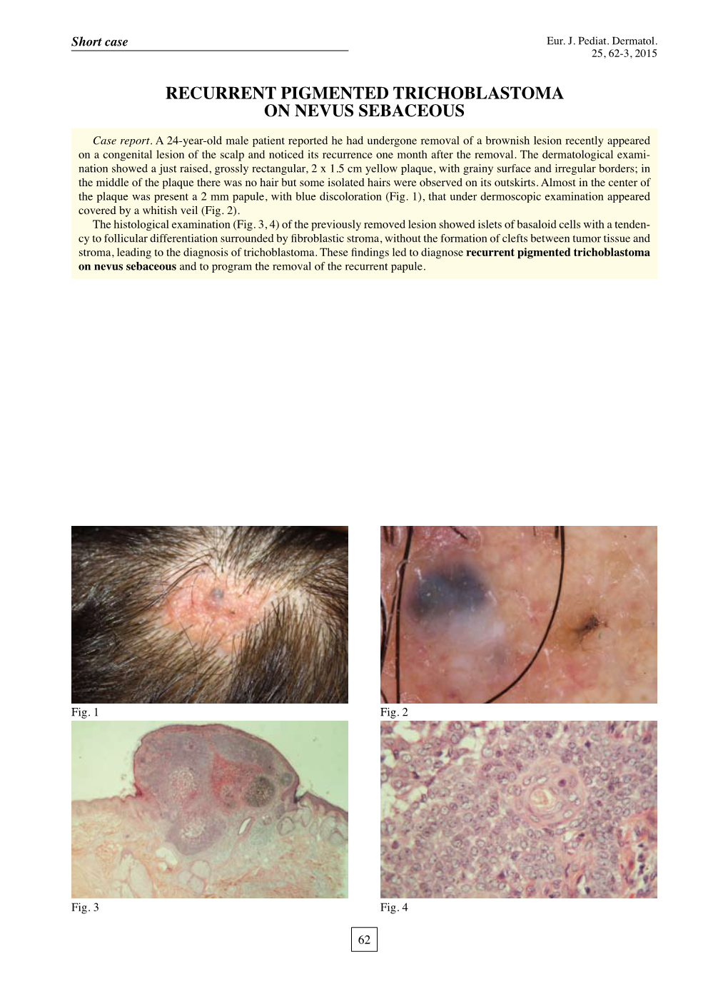 Recurrent Pigmented Trichoblastoma on Nevus Sebaceous