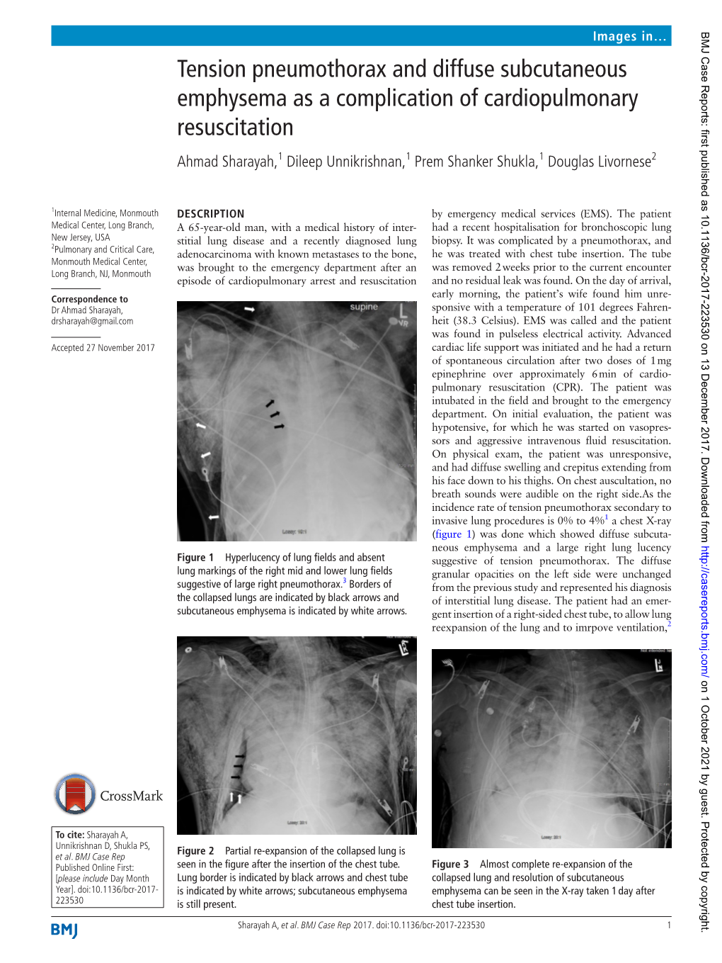 Tension Pneumothorax and Diffuse Subcutaneous Emphysema As A