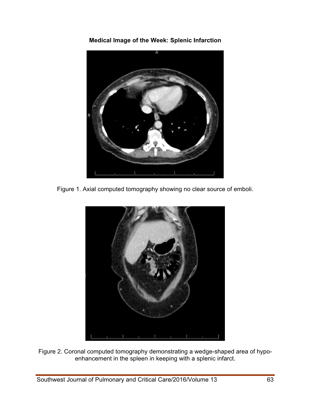 Splenic Infarction, Consideration in a Patient with Acute Left Upper