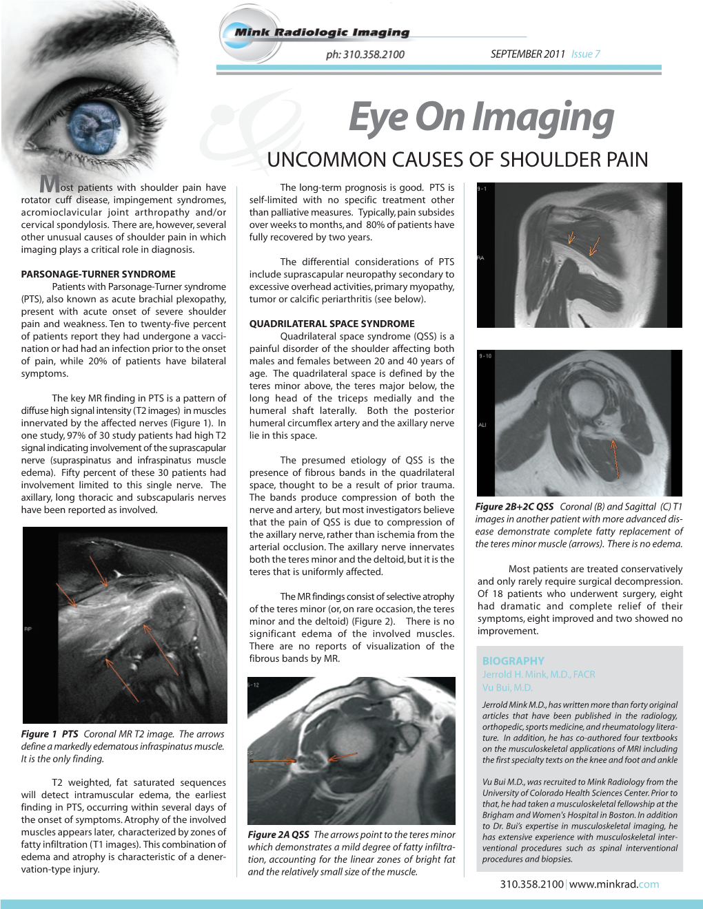 Eye on Imaging UNCOMMON CAUSES of SHOULDER PAIN Most Patients with Shoulder Pain Have the Long-Term Prognosis Is Good