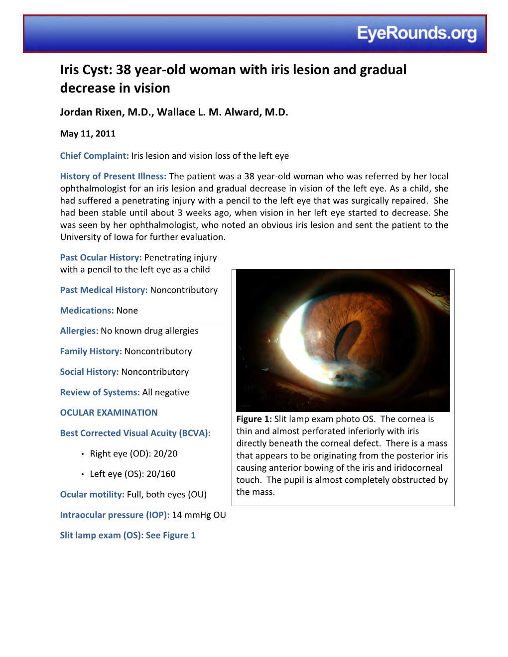Iris Cyst: 38 Year-Old Woman with Iris Lesion and Gradual Decrease in Vision Jordan Rixen, M.D., Wallace L