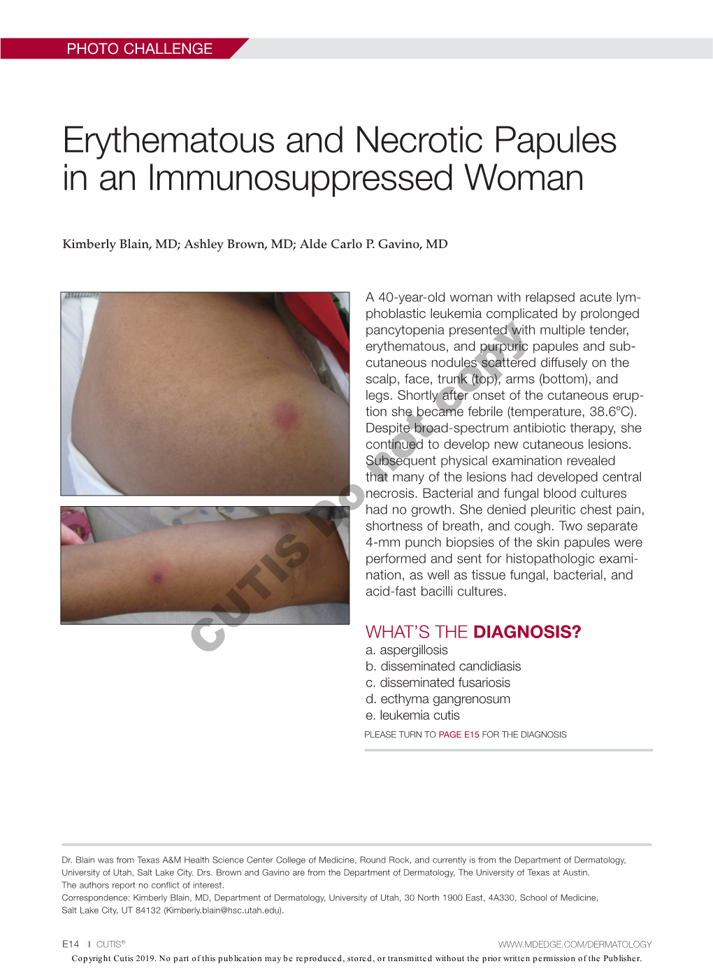 Erythematous and Necrotic Papules in an Immunosuppressed Woman