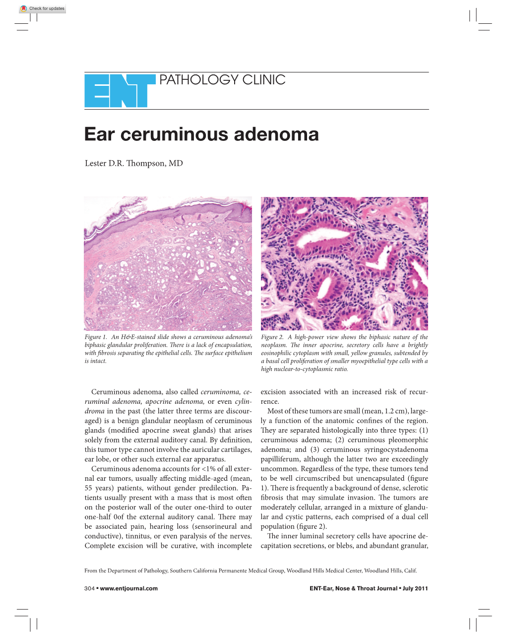 Ear Ceruminous Adenoma