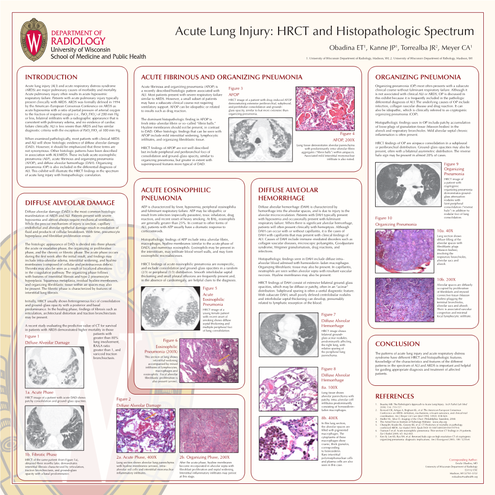 Diffuse Alveolar Damage HRCT Findings of OP Are Airspace Consolidation in a Subpleural (DAD)