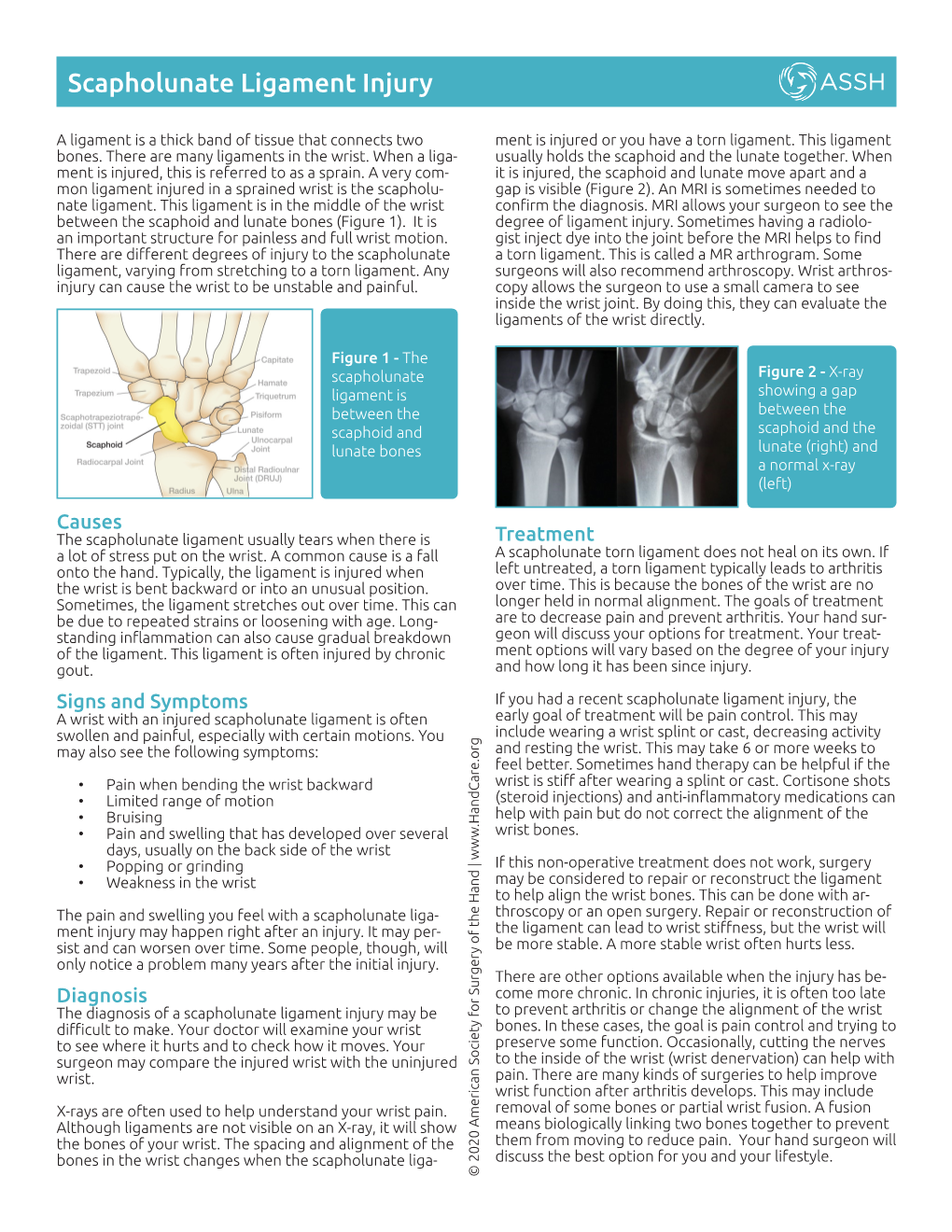 Scapholunate Ligament Injury