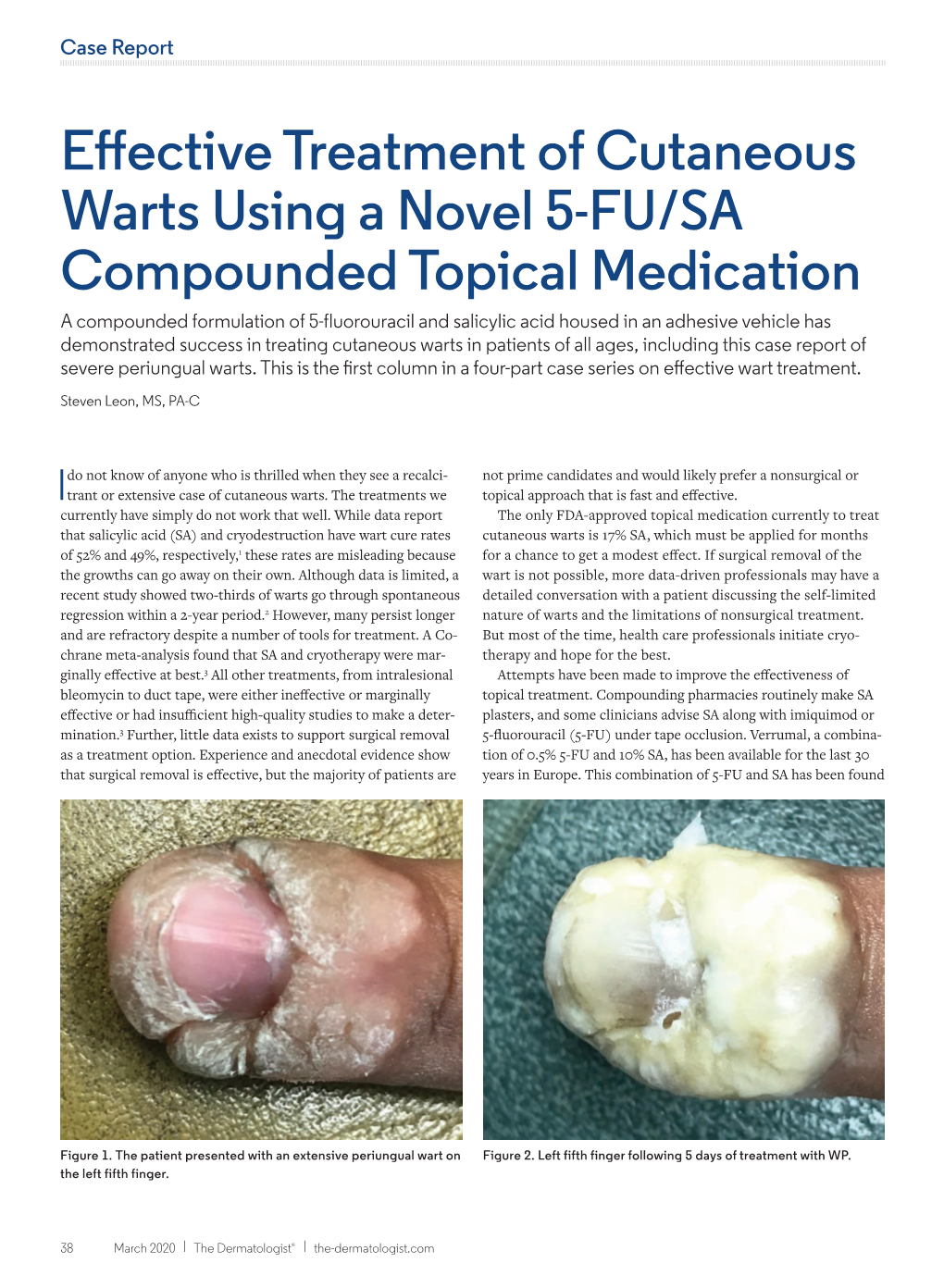 Effective Treatment of Cutaneous Warts