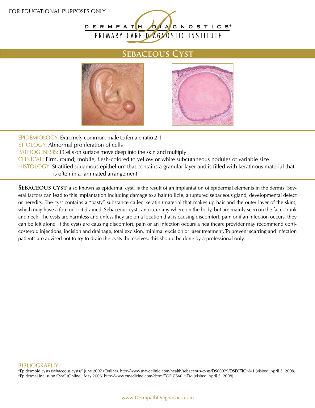 Sebaceous Cyst ! !