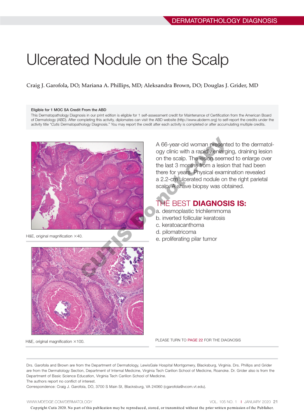 Ulcerated Nodule on the Scalp