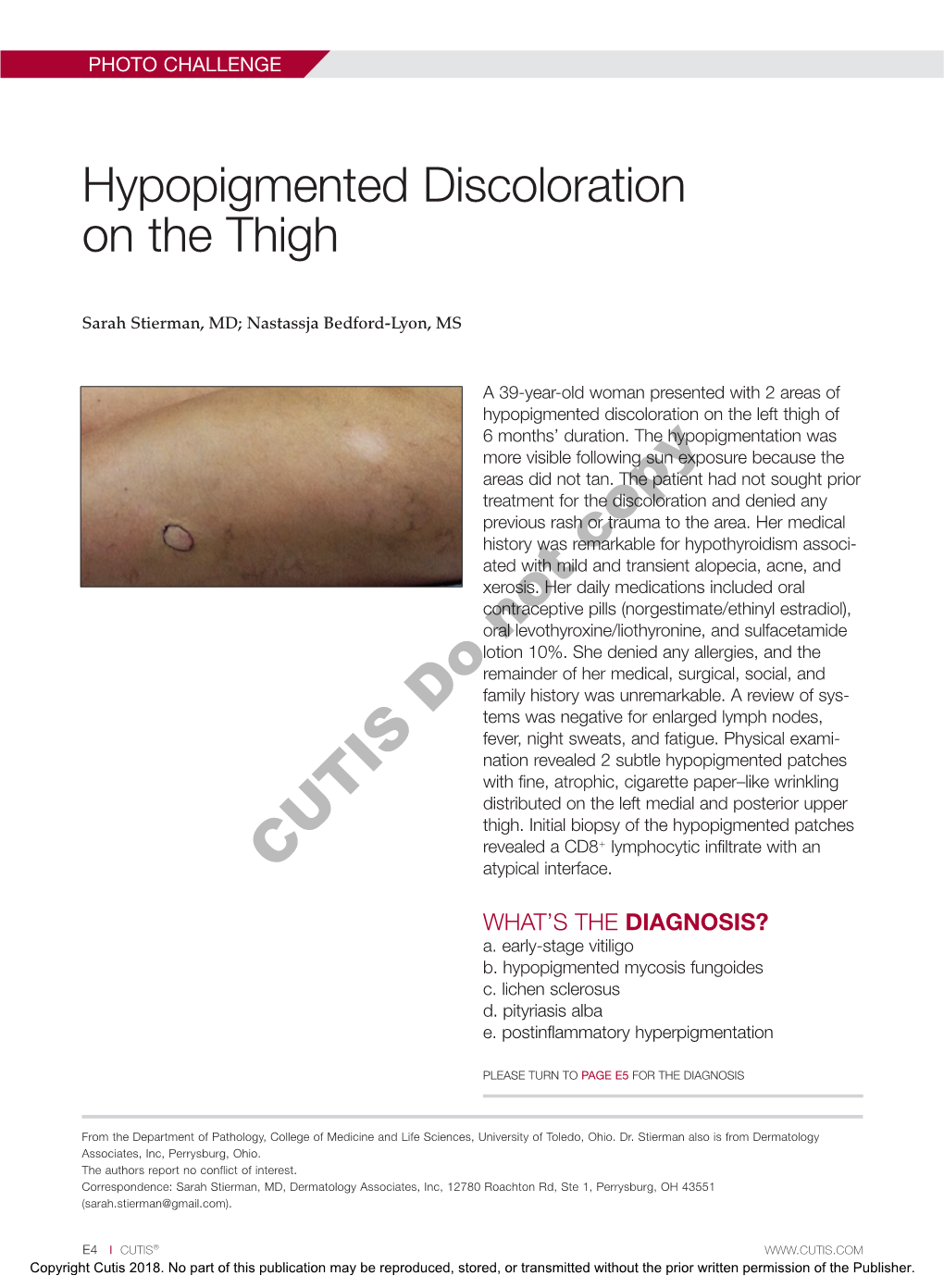 Hypopigmented Discoloration on the Thigh