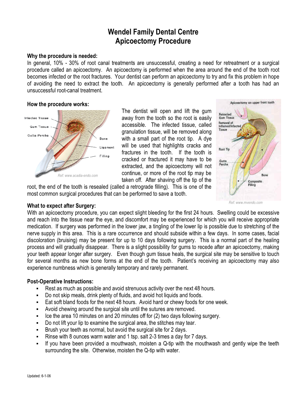 Wendel Family Dental Centre Apicoectomy Procedure