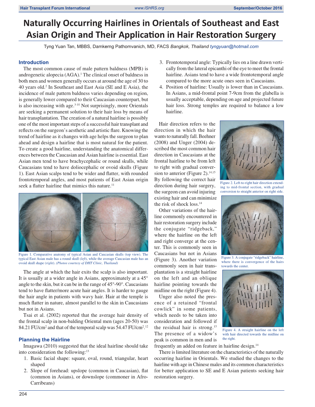 Naturally Occurring Hairlines in Orientals of Southeast and East