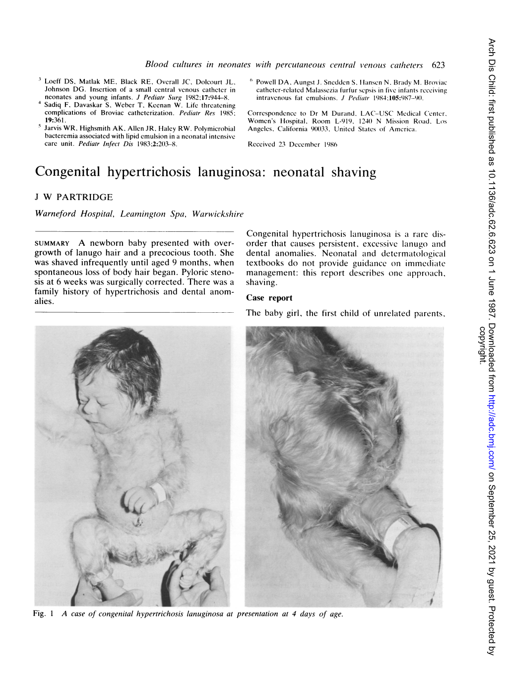 Congenital Hypertrichosis Lanuginosa:Neonatal Shaving