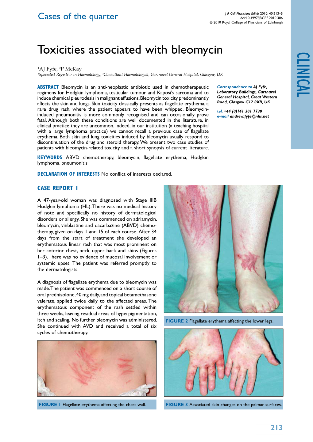 Toxicities Associated with Bleomycin Clinical