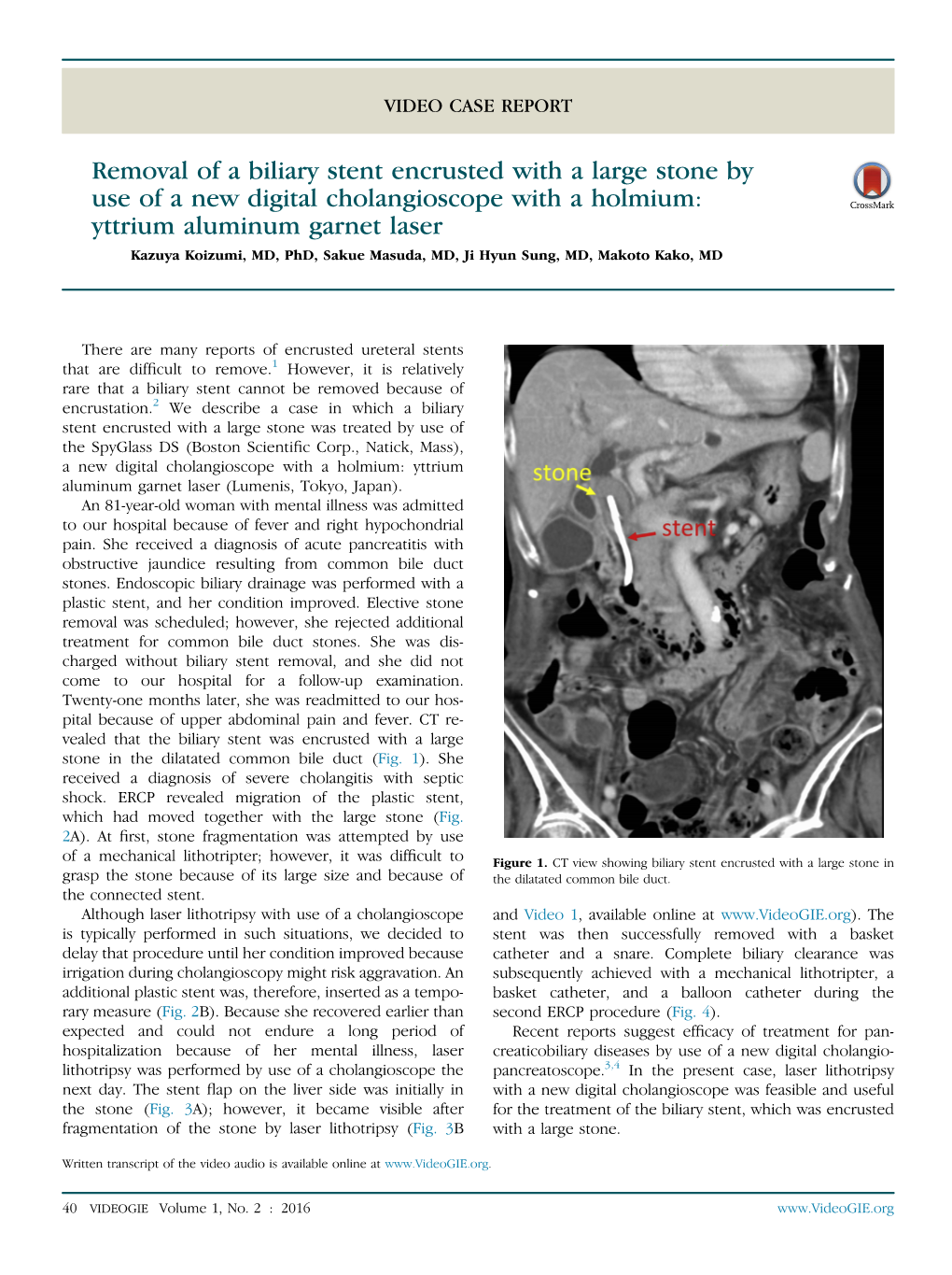 Removal of a Biliary Stent Encrusted with a Large Stone by Use of a New Digital Cholangioscope with a Holmium