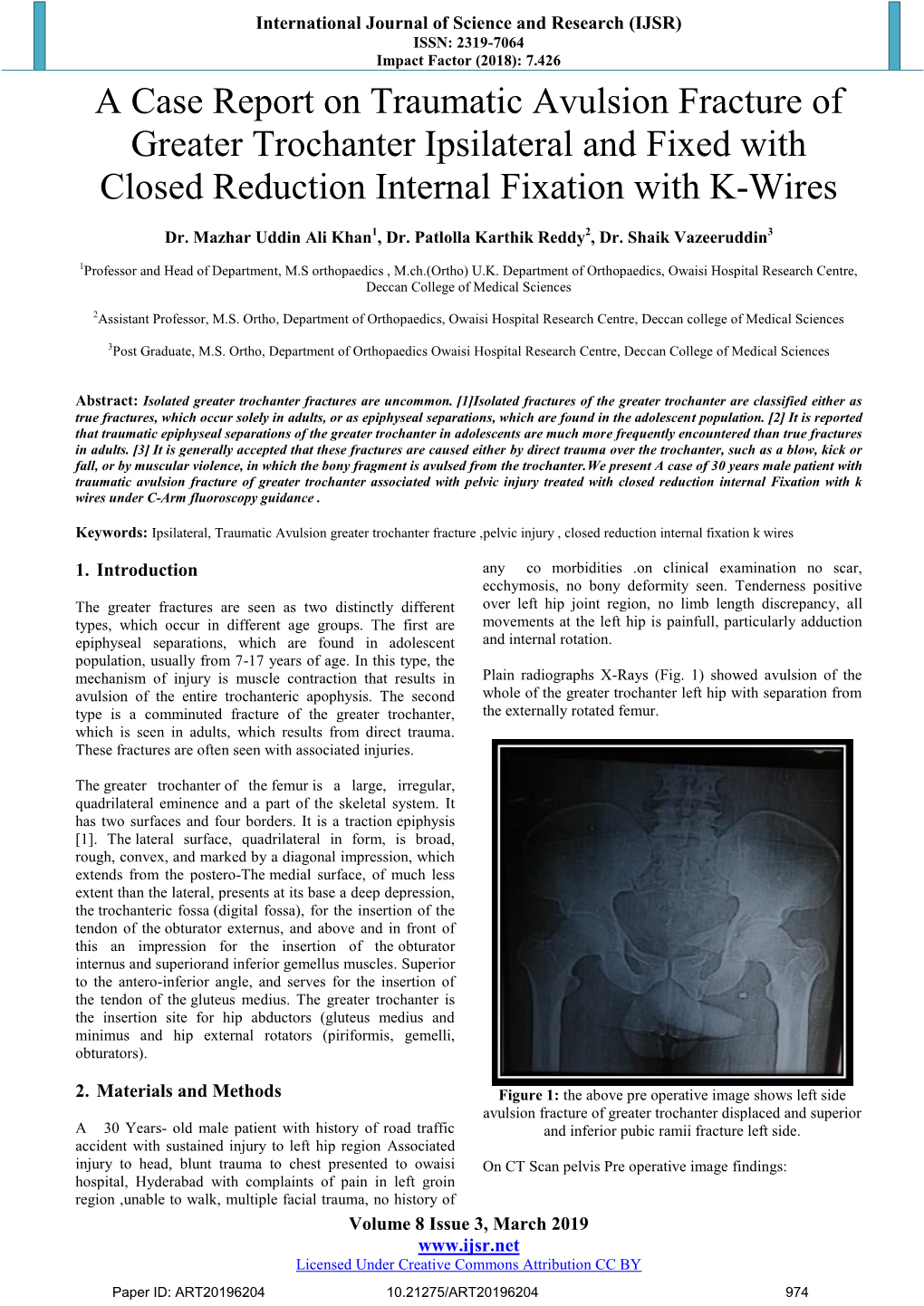 A Case Report on Traumatic Avulsion Fracture of Greater Trochanter Ipsilateral and Fixed with Closed Reduction Internal Fixation with K-Wires