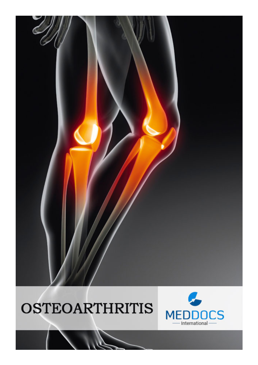 Intoxination with Grass Pea: a Multi System Pathology: Neuro-Vasculo-Osteo-Lathyrism