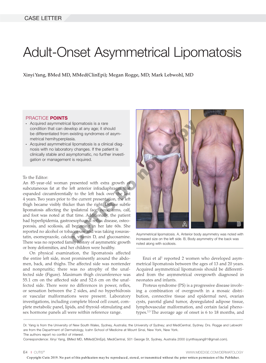 Adult-Onset Asymmetrical Lipomatosis