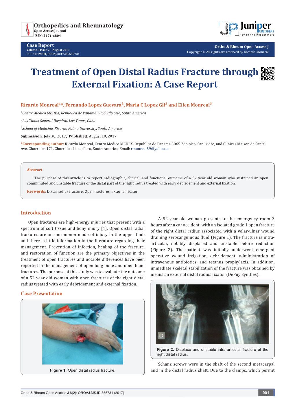 Treatment of Open Distal Radius Fracture Through External Fixation: a Case Report