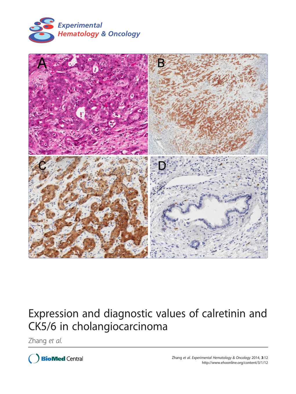 Expression and Diagnostic Values of Calretinin and CK5/6 in Cholangiocarcinoma Zhang Et Al