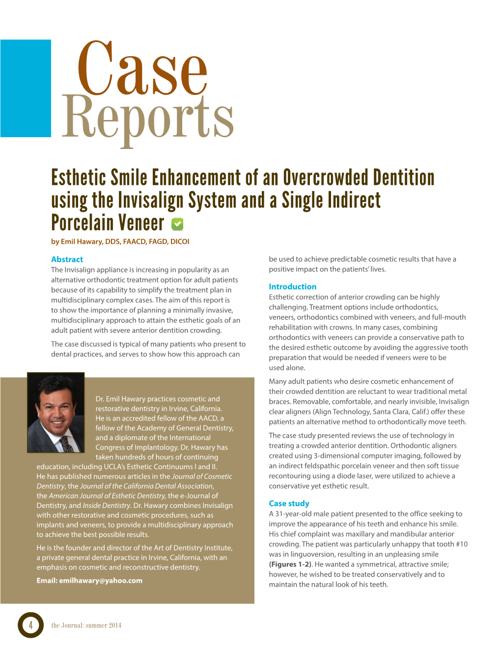 Esthetic Smile Enhancement of an Overcrowded Dentition Using The