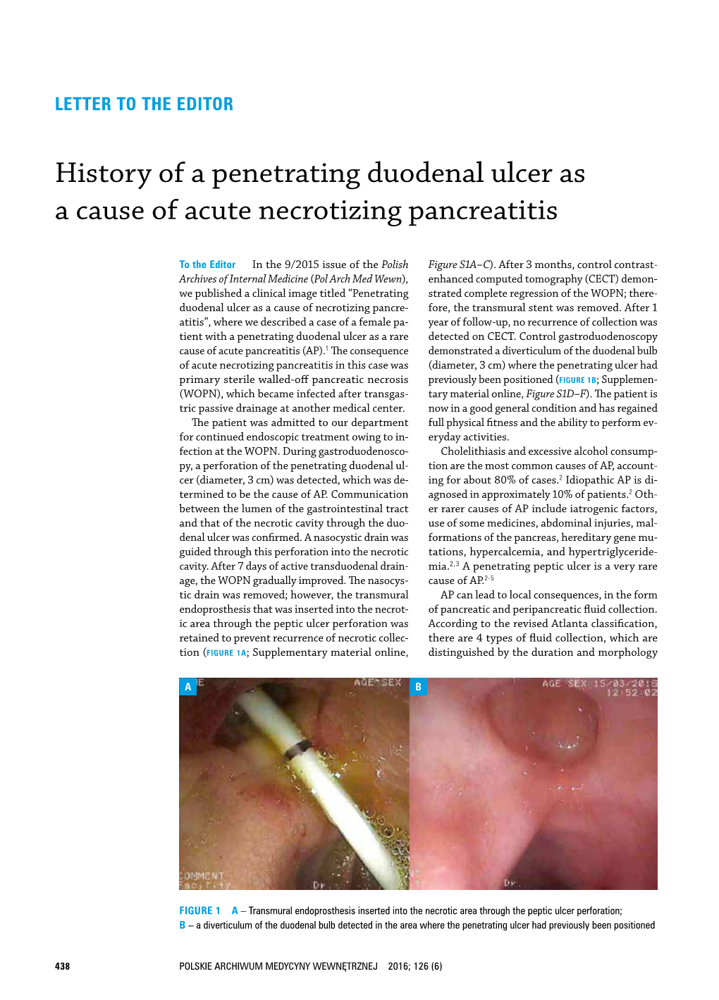 History of a Penetrating Duodenal Ulcer As a Cause of Acute Necrotizing Pancreatitis