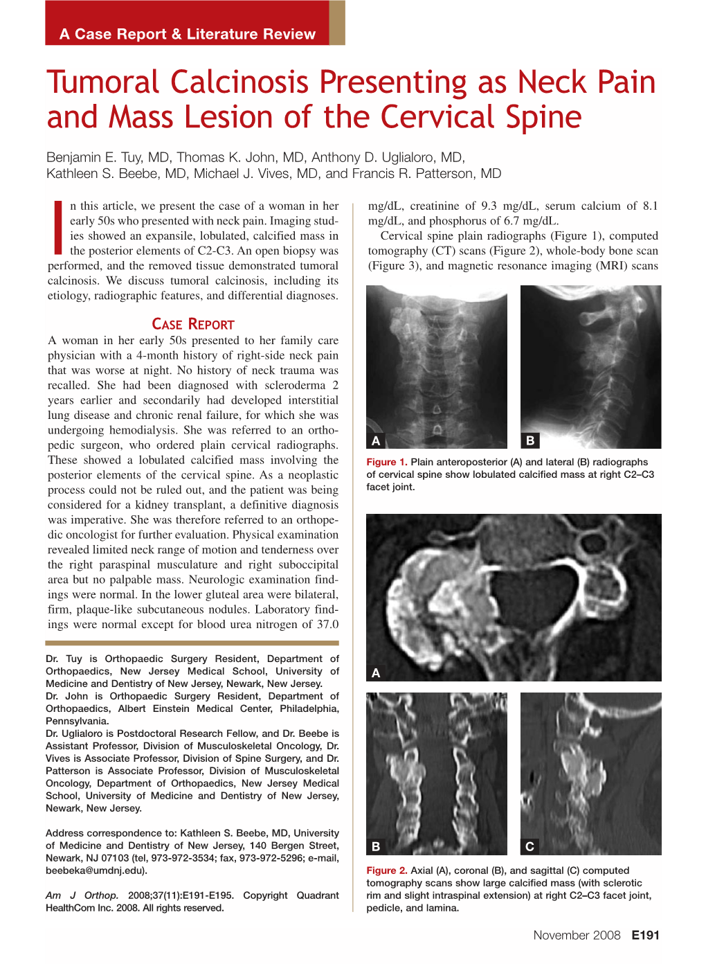 Tumoral Calcinosis Presenting As Neck Pain and Mass Lesion of the Cervical Spine