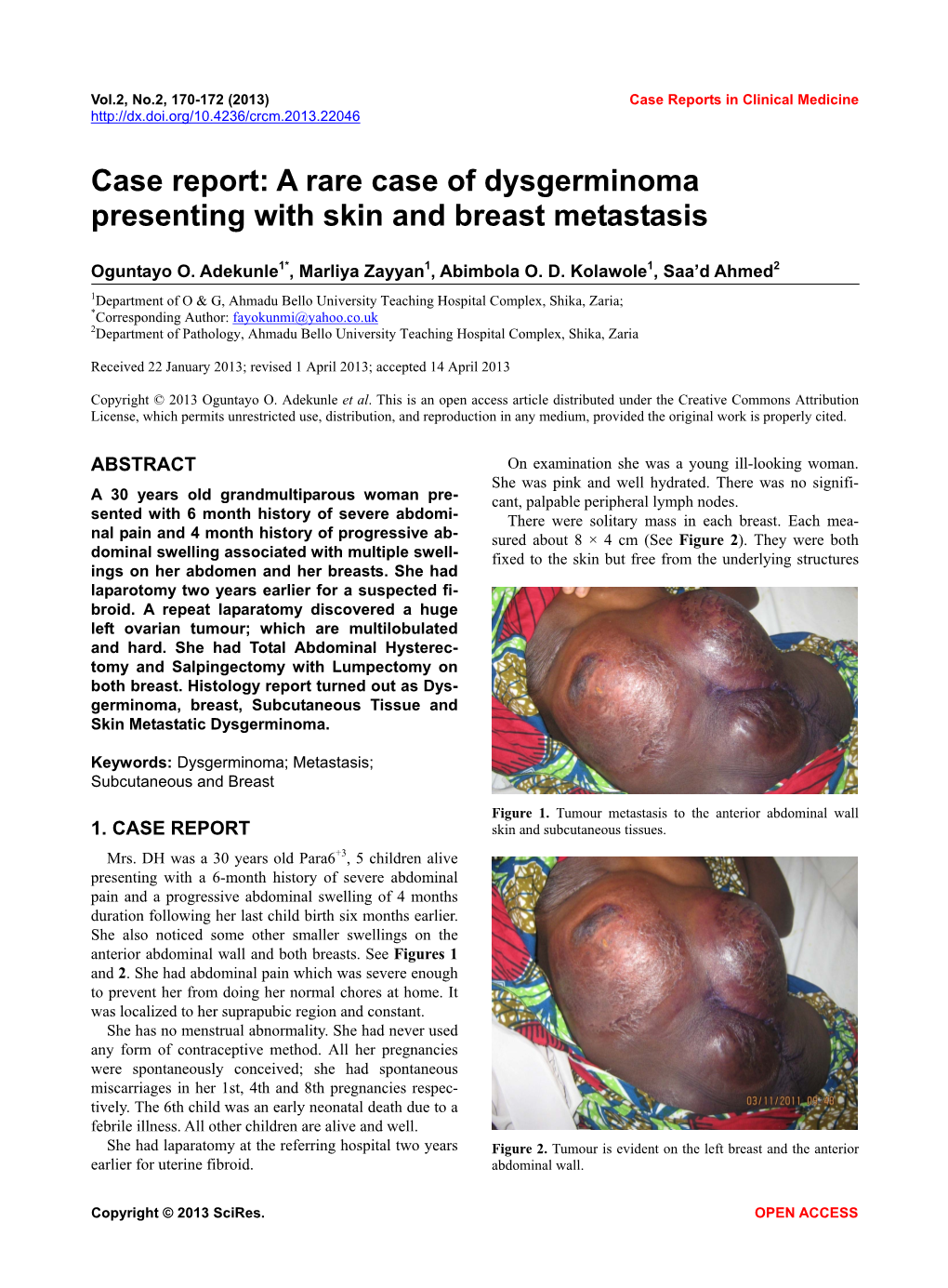 A Rare Case of Dysgerminoma Presenting with Skin and Breast Metastasis
