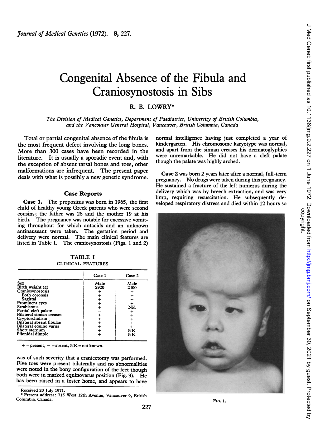 Craniosynostosis in Sibs R