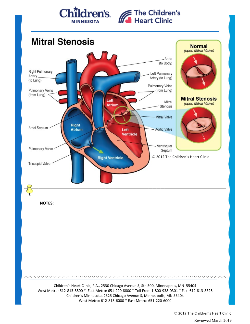 Mitral Stenosis (MS)