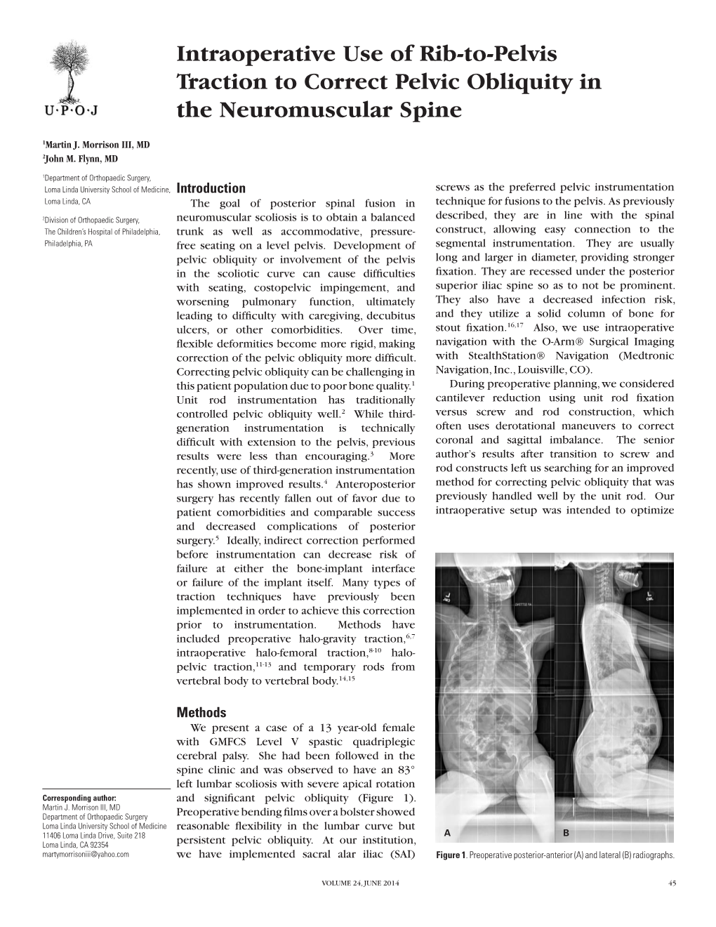 Intraoperative Use of Rib-To-Pelvis Traction to Correct Pelvic Obliquity in the Neuromuscular Spine