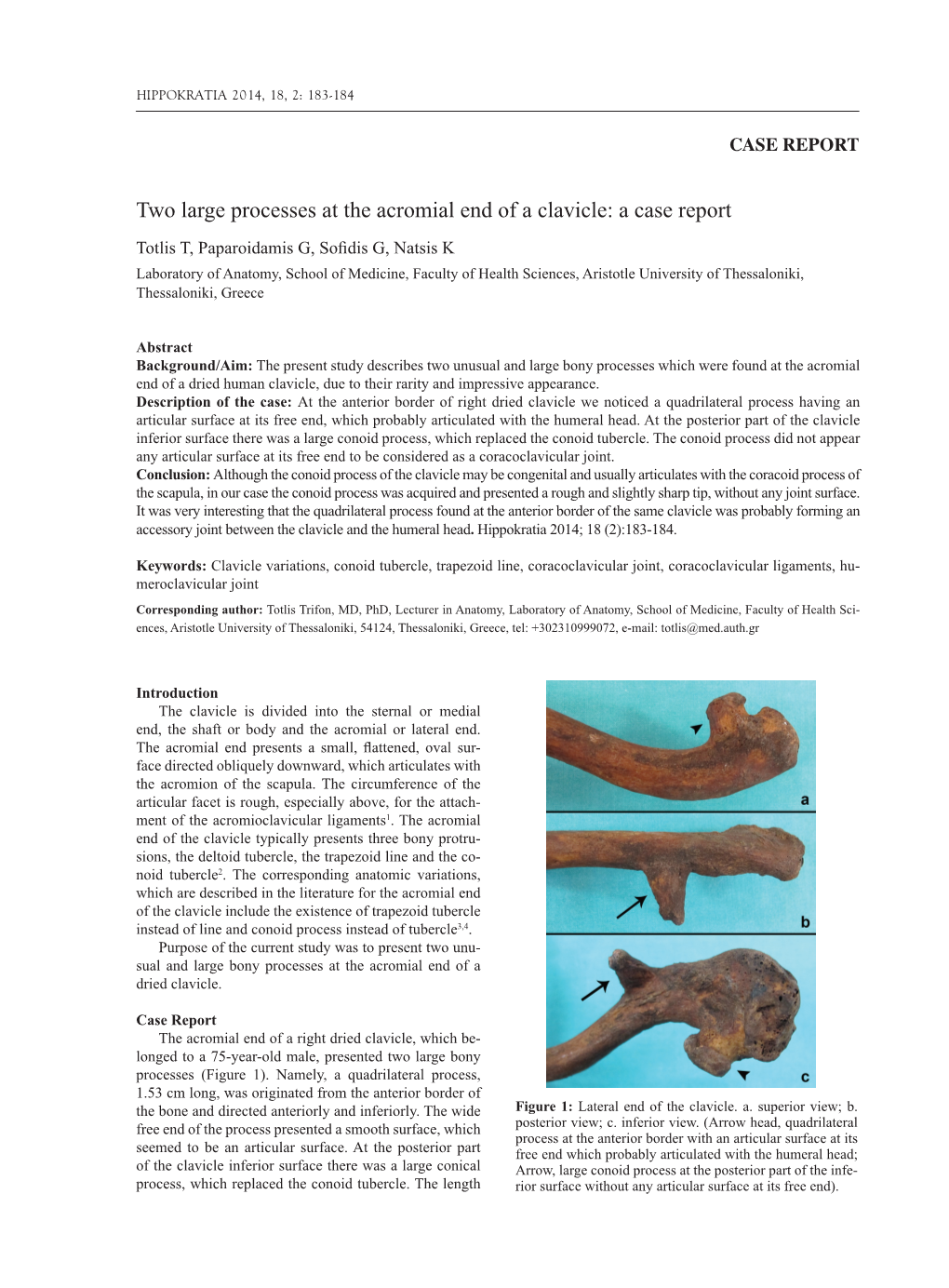 Two Large Processes at the Acromial End of a Clavicle