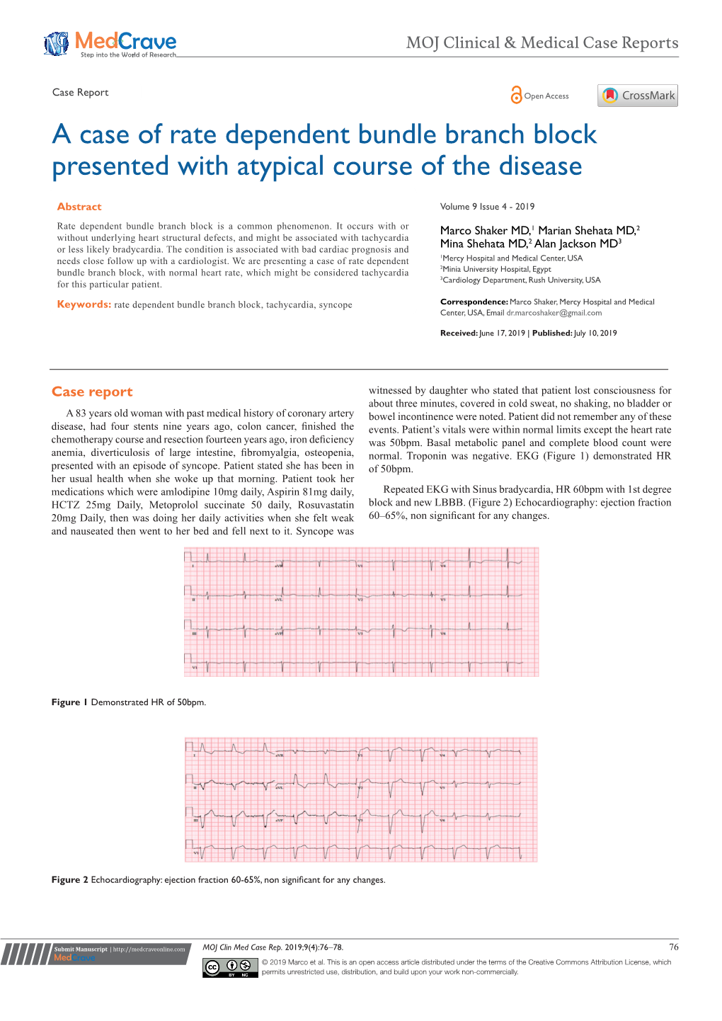 A Case of Rate Dependent Bundle Branch Block Presented with Atypical Course of the Disease