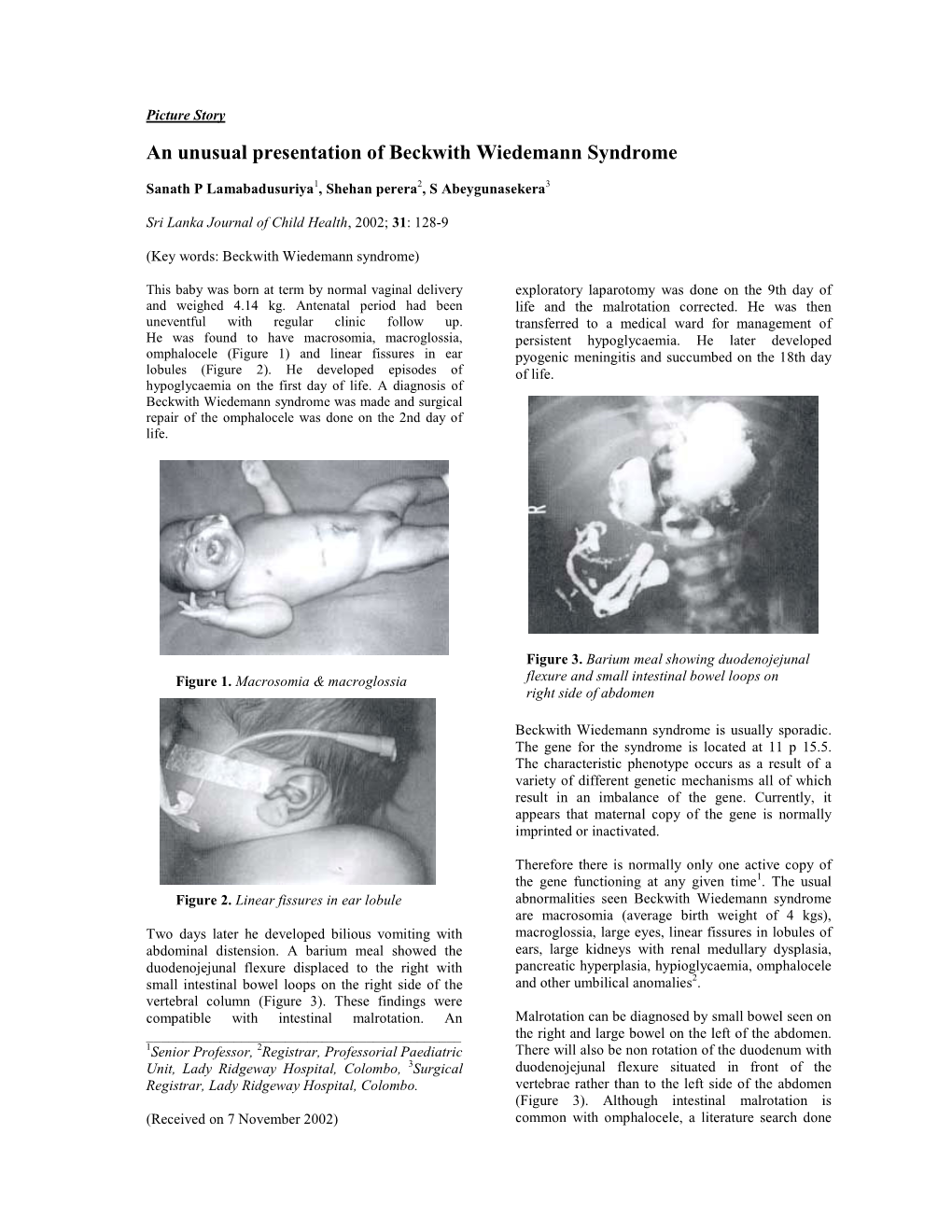 An Unusual Presentation of Beckwith Wiedemann Syndrome