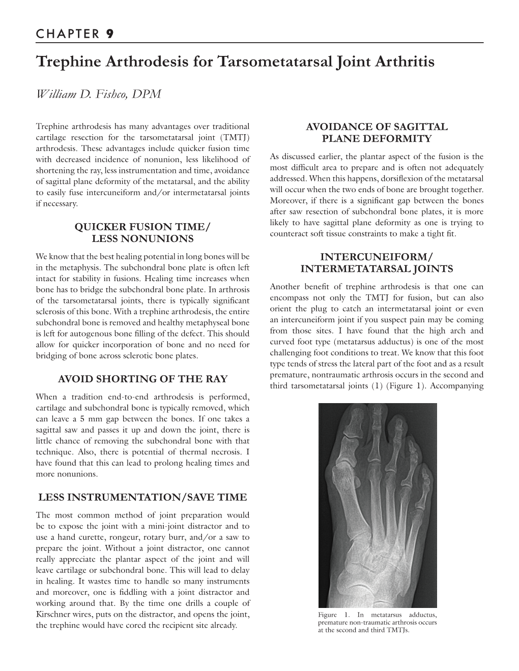 Trephine Arthrodesis for Tarsometatarsal Joint Arthritis