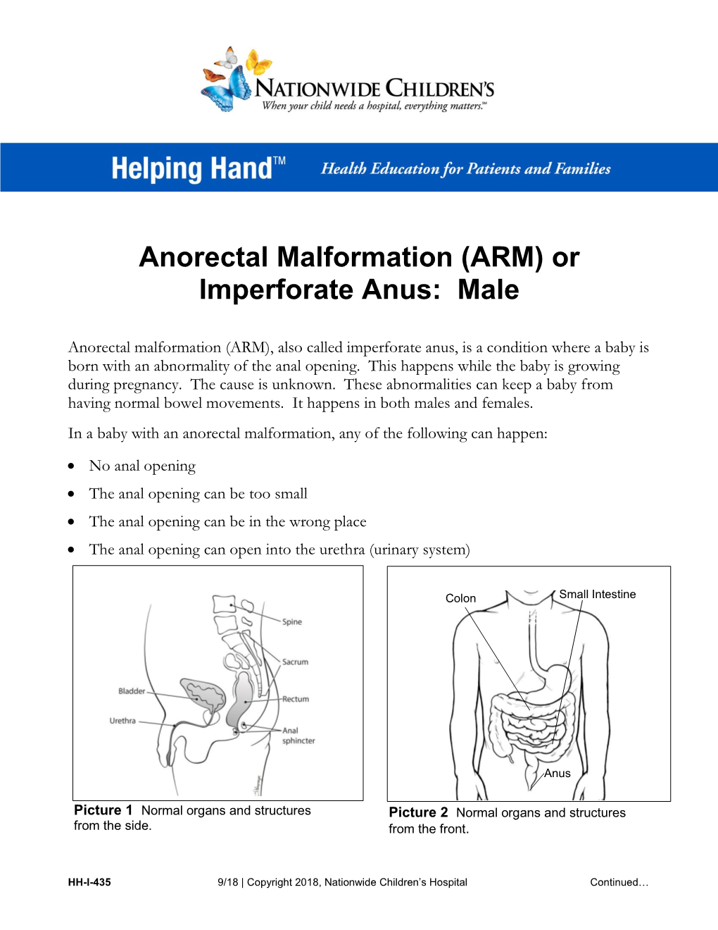 Anorectal Malformation (ARM) Or Imperforate Anus: Male