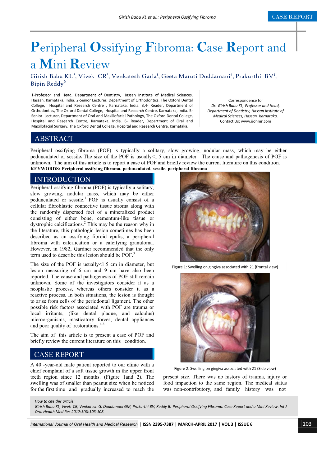 Peripheral Ossifying Fibroma CASE REPORT