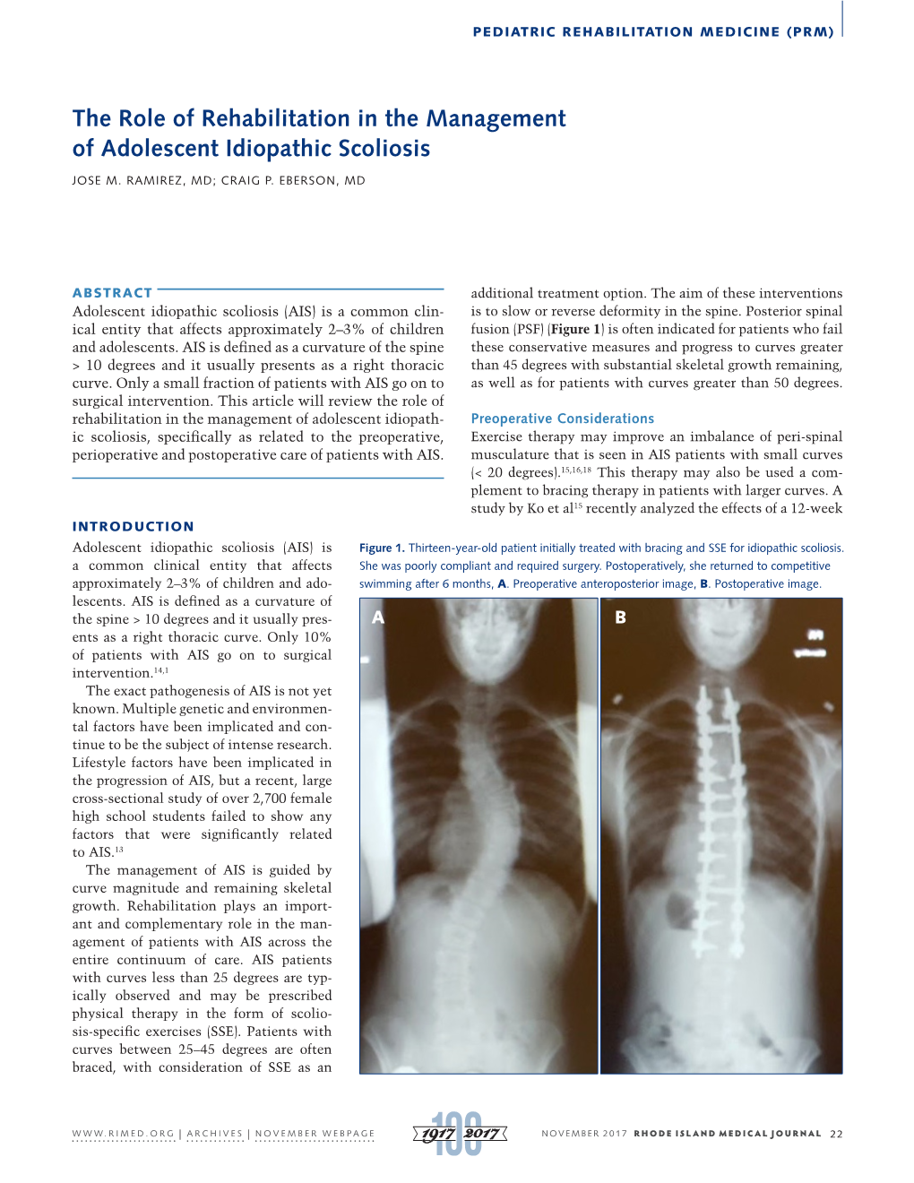 The Role of Rehabilitation in the Management of Adolescent Idiopathic Scoliosis