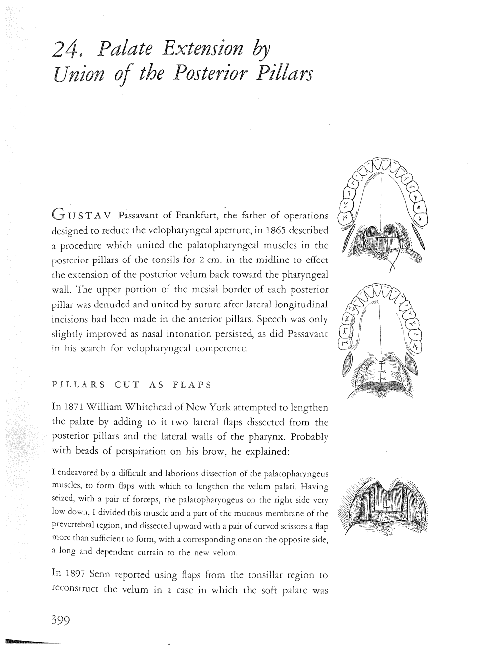24. Palate Extension by Union of the Posterior Pillars