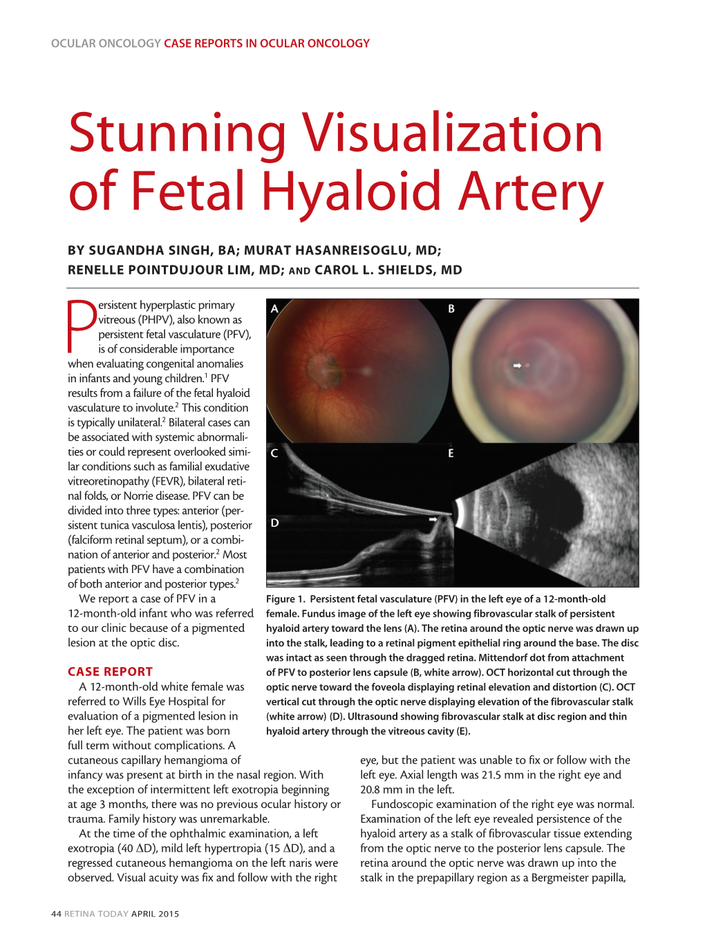 Stunning Visualization of Fetal Hyaloid Artery