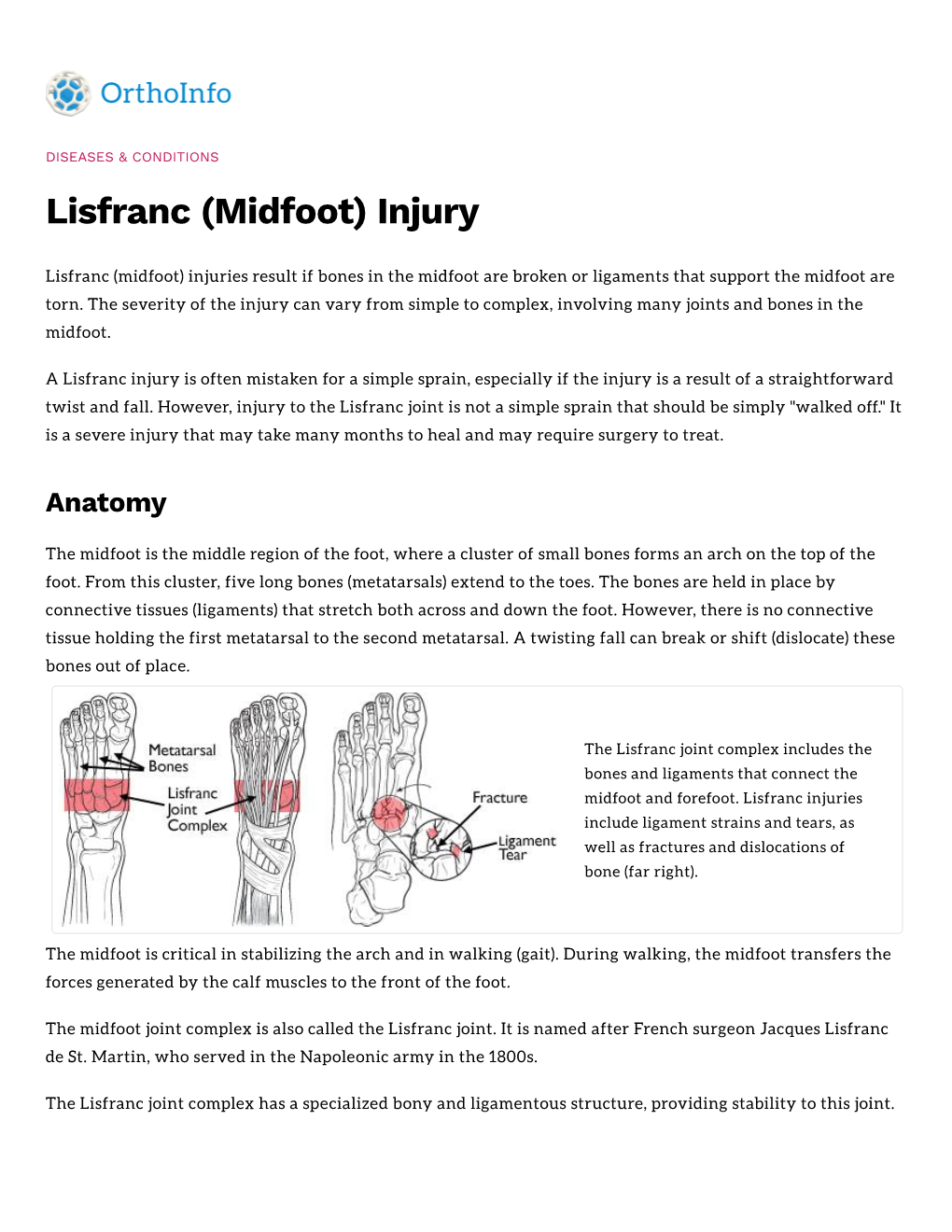 Lisfranc (Midfoot) Injury