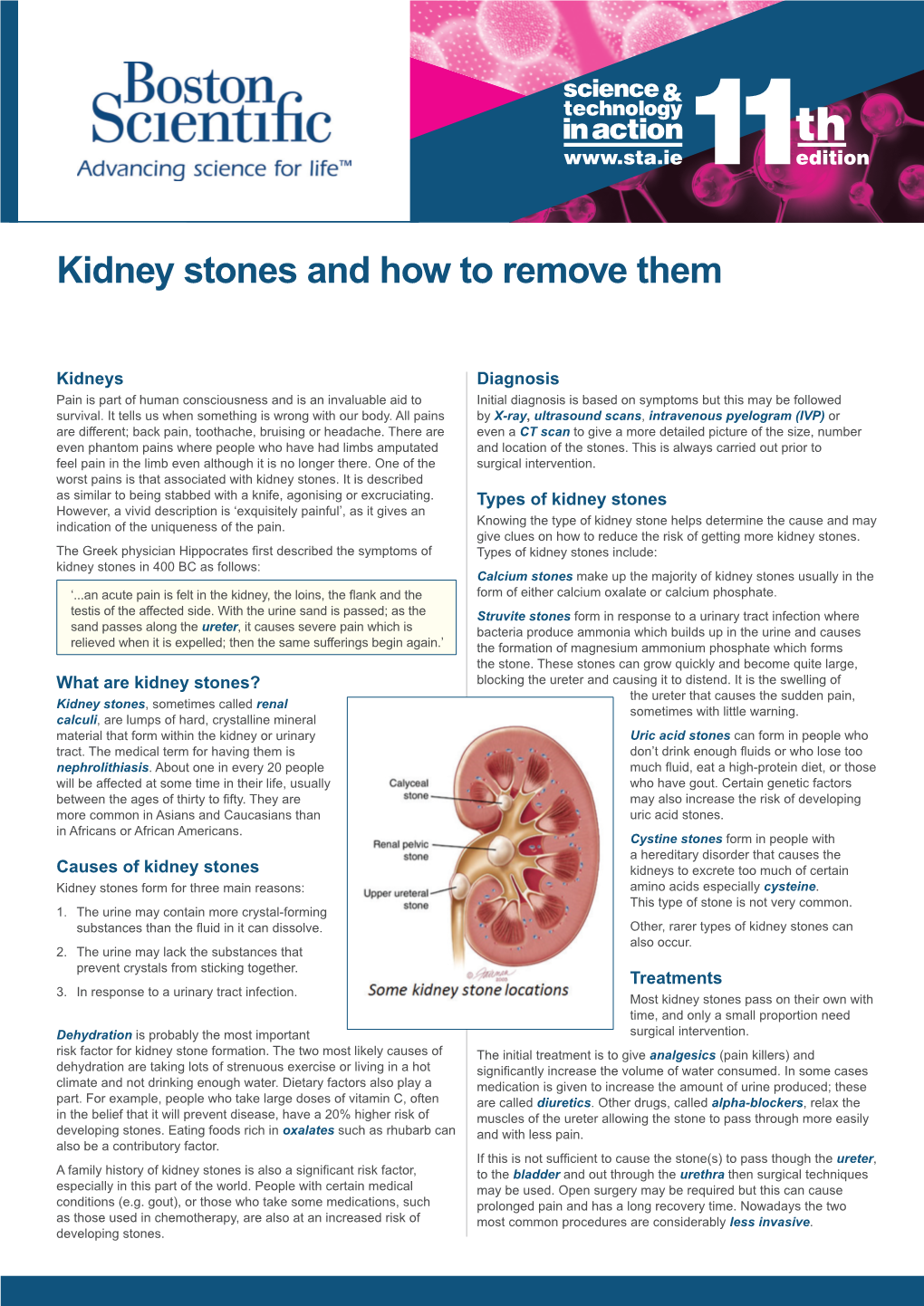 Kidney Stones and How to Remove Them Kidney Stones and How to Remove Them