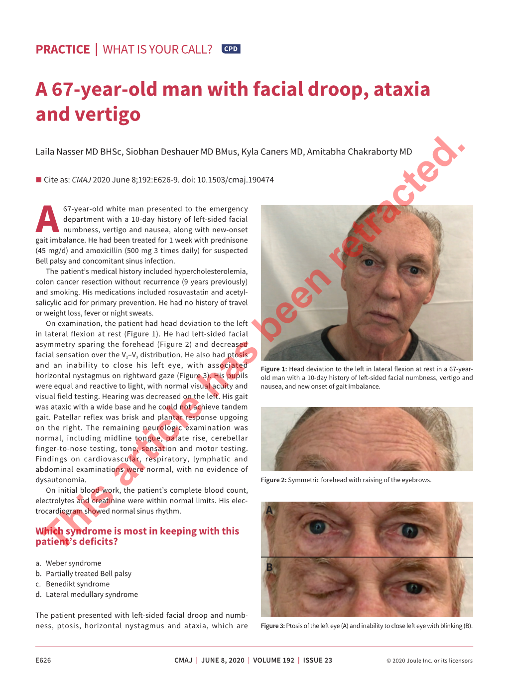 A 67-Year-Old Man with Facial Droop, Ataxia and Vertigo