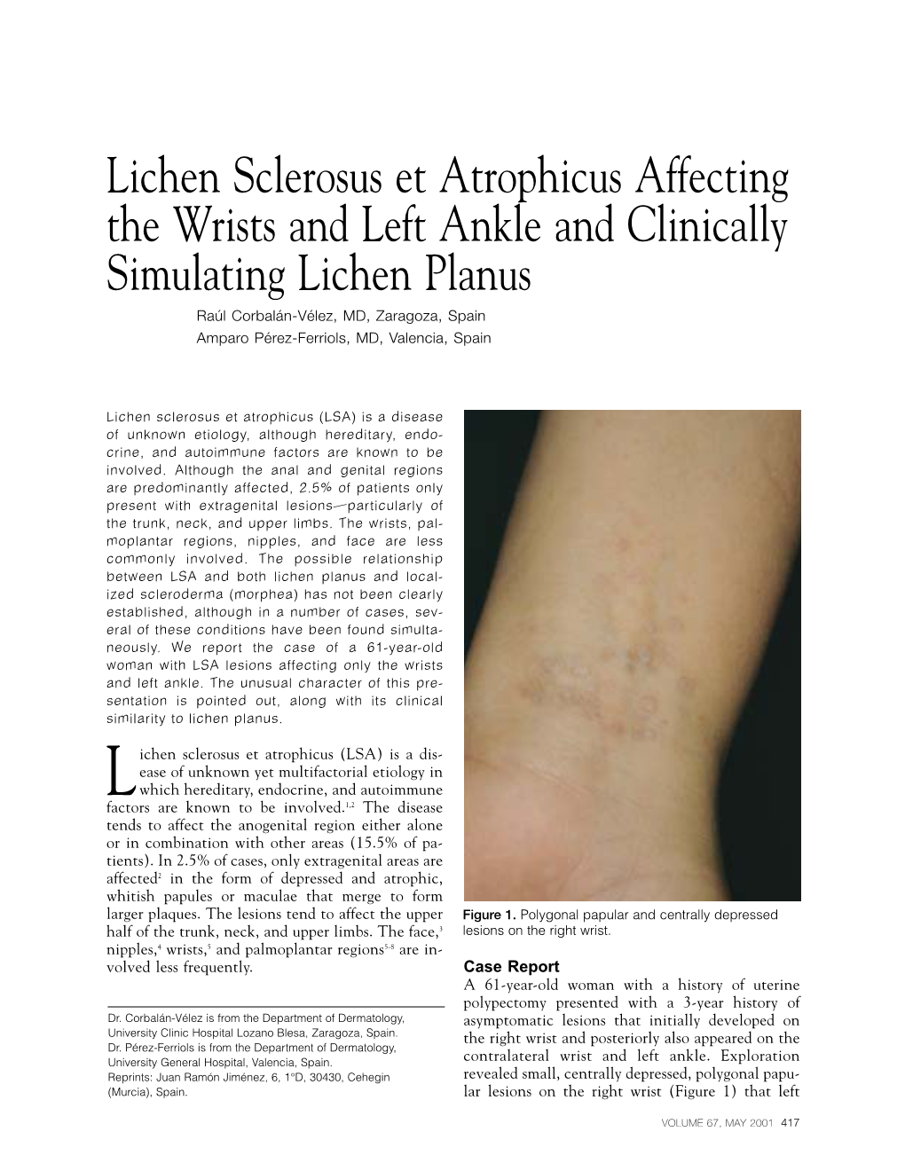 Lichen Sclerosus Et Atrophicus Affecting the Wrists and Left Ankle