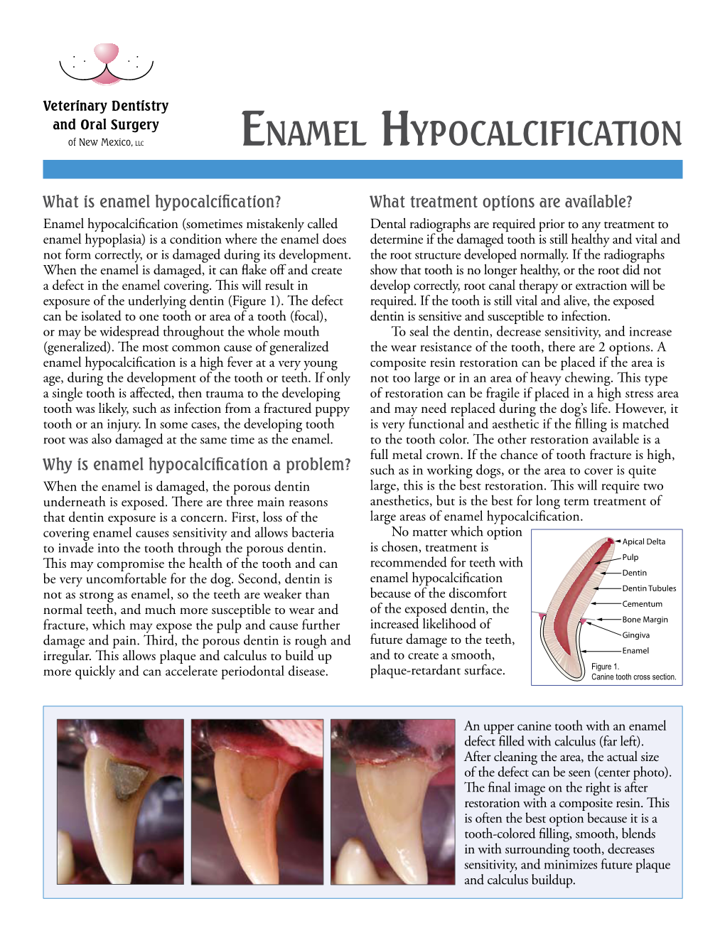 Enamel Hypocalcification